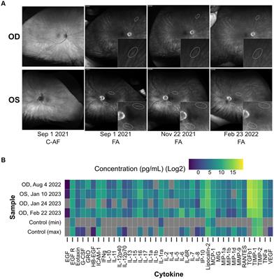 Case report: Longitudinal evaluation and treatment of a melanoma-associated retinopathy patient